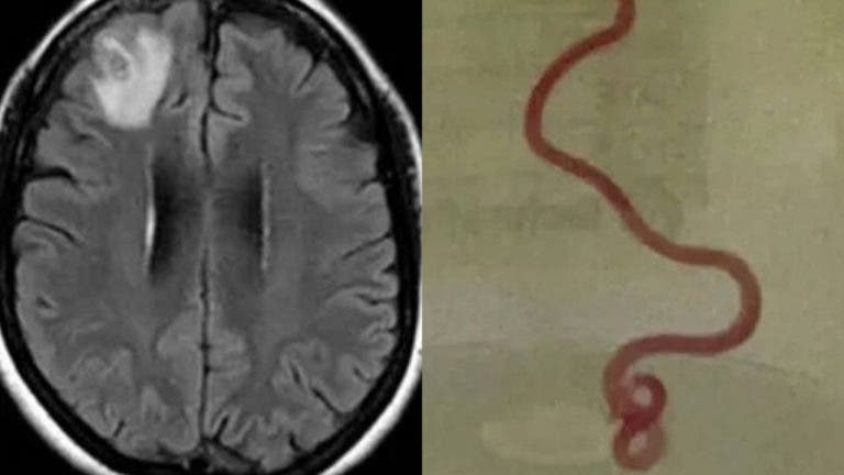 Lombriz de ocho centímetros extraída del cerebro de una paciente.
