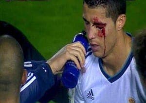 Cristiano Ronaldo tras el golpe de Navarro